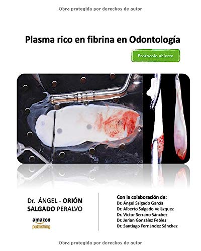 Plasma rico en fibrina en Odontología: Protocolo abierto